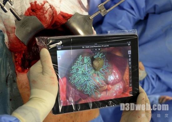 iPad虚拟现实帮助医生完成肝脏手术