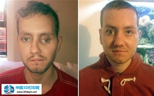 惊！面部骨折男子用3D打印技术恢复容貌 