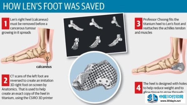 heel-bone-3d-printed-cancer-calcaneus-4