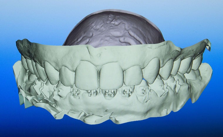 患者的整个牙床3D模型已经采集完成。