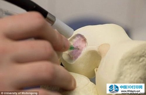 类似3D打印 新科技可“画”出骨骼组织