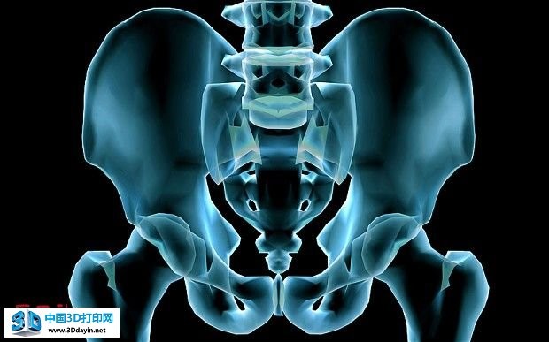 英国医生使用3D打印技术为癌症患者更换骨盆