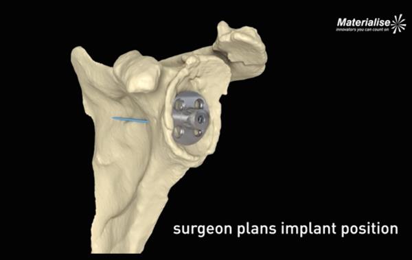 Mathys引进Materialise的3D肩关节手术规划软件