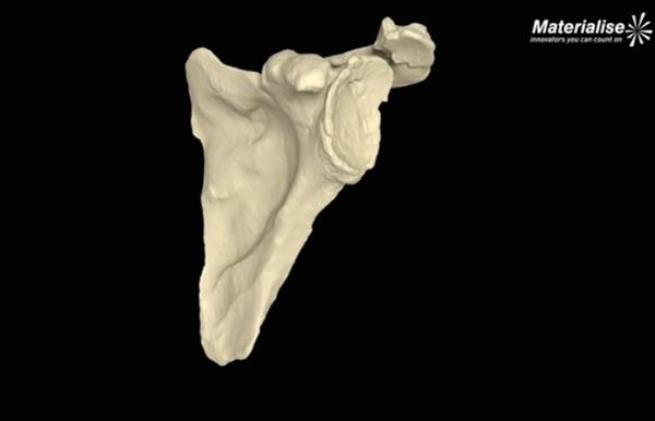 Mathys引进Materialise的3D肩关节手术规划软件