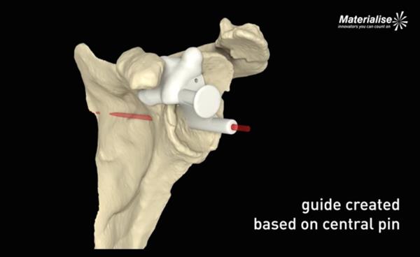 Mathys引进Materialise的3D肩关节手术规划软件