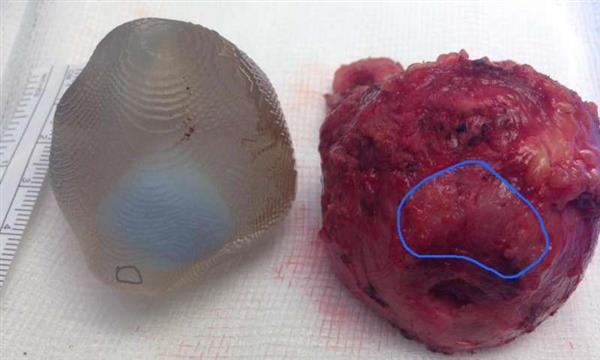 伦敦医生借助3D打印成功切除前列腺肿瘤