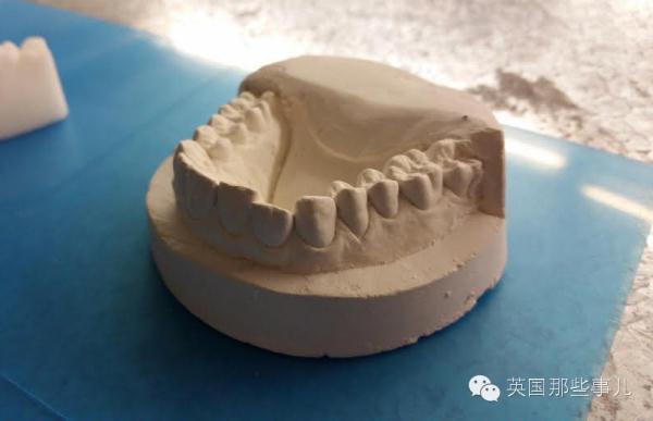 理工男的极致：牙医太贵，他干脆给自己3D打印了12副矫形牙套...居然成功了！