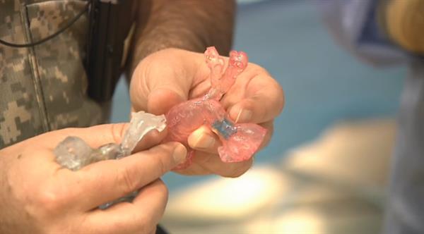 洛杉矶医生借3D打印心脏模型挽救婴儿的生命